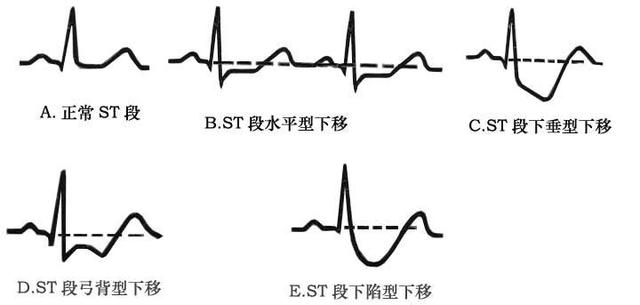 学看心电图(健康知识-摘自网络) - 平平淡淡 - 平平淡淡