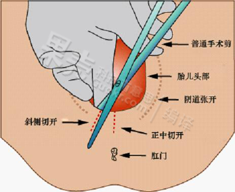 "顺产也要挨一刀",会阴侧切术残害产妇吗?