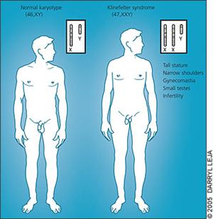 克林菲尔特综合征,其性染色体为XXY。图片来自www.health-reply.com